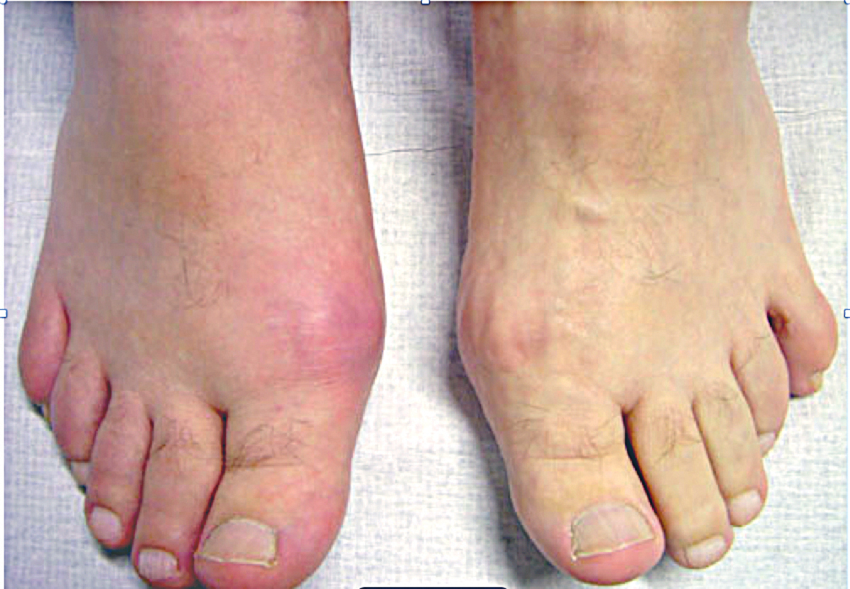 Lưu ý cho người bị Gout