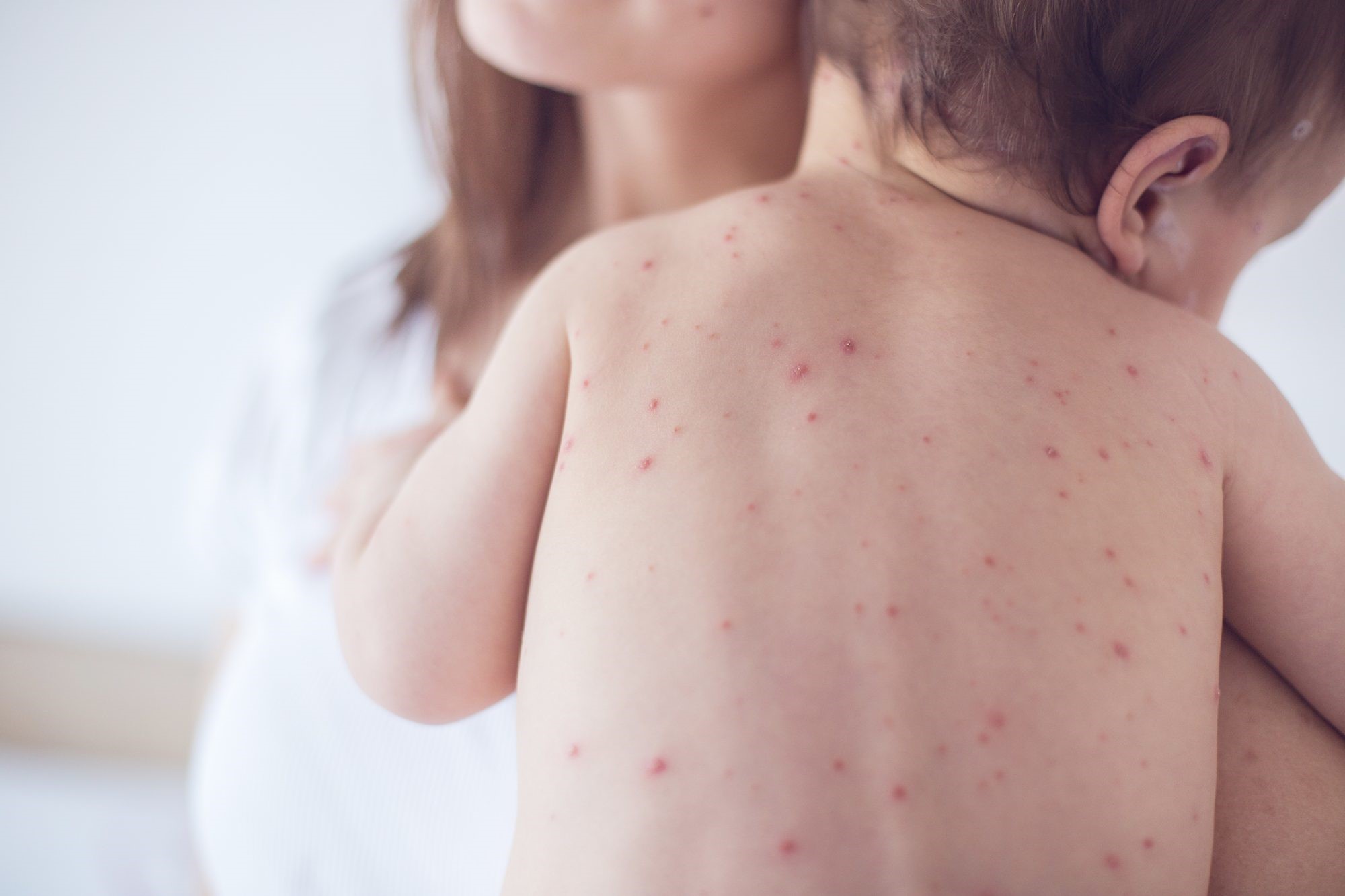 Cách điều trị bệnh sốt xuất hiện ở trẻ em