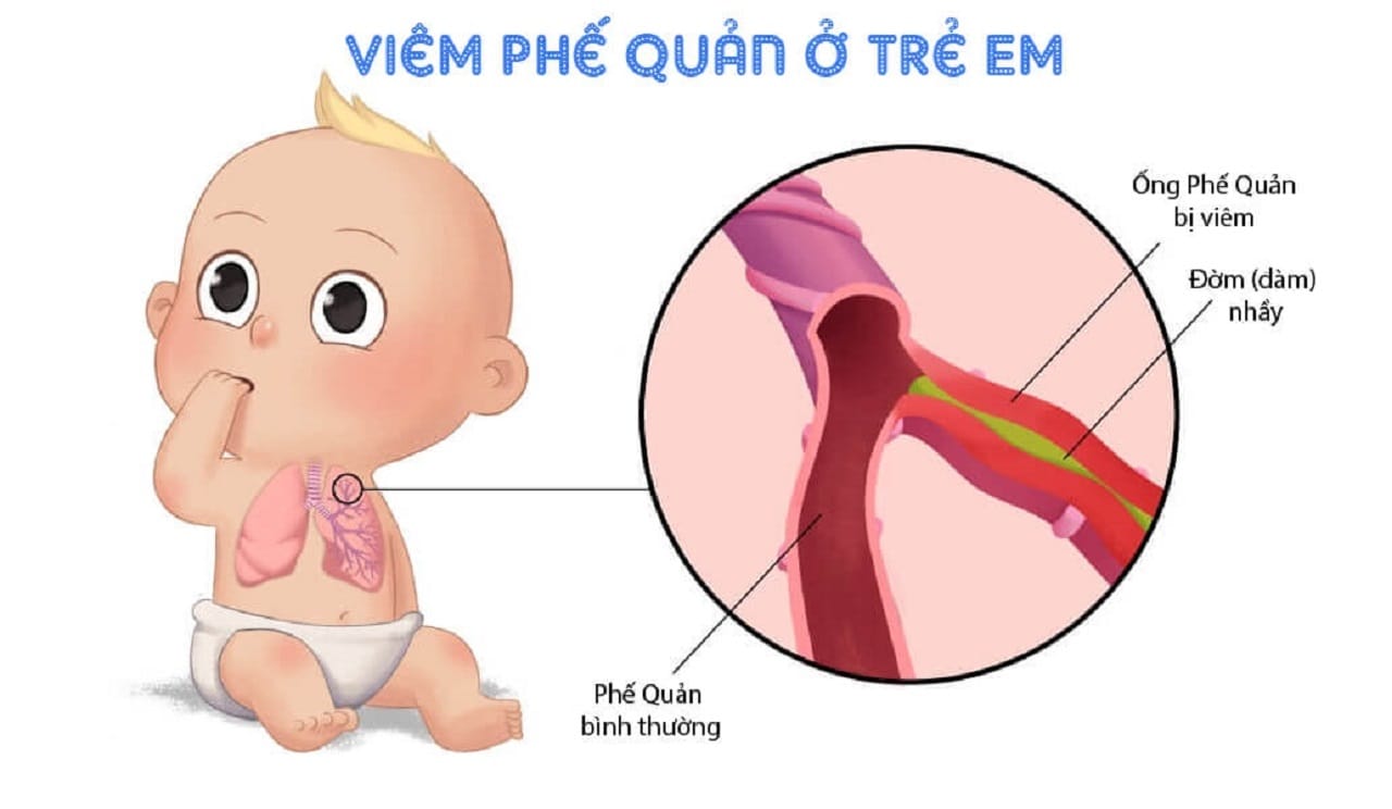 Bệnh viêm phế quản là gì?