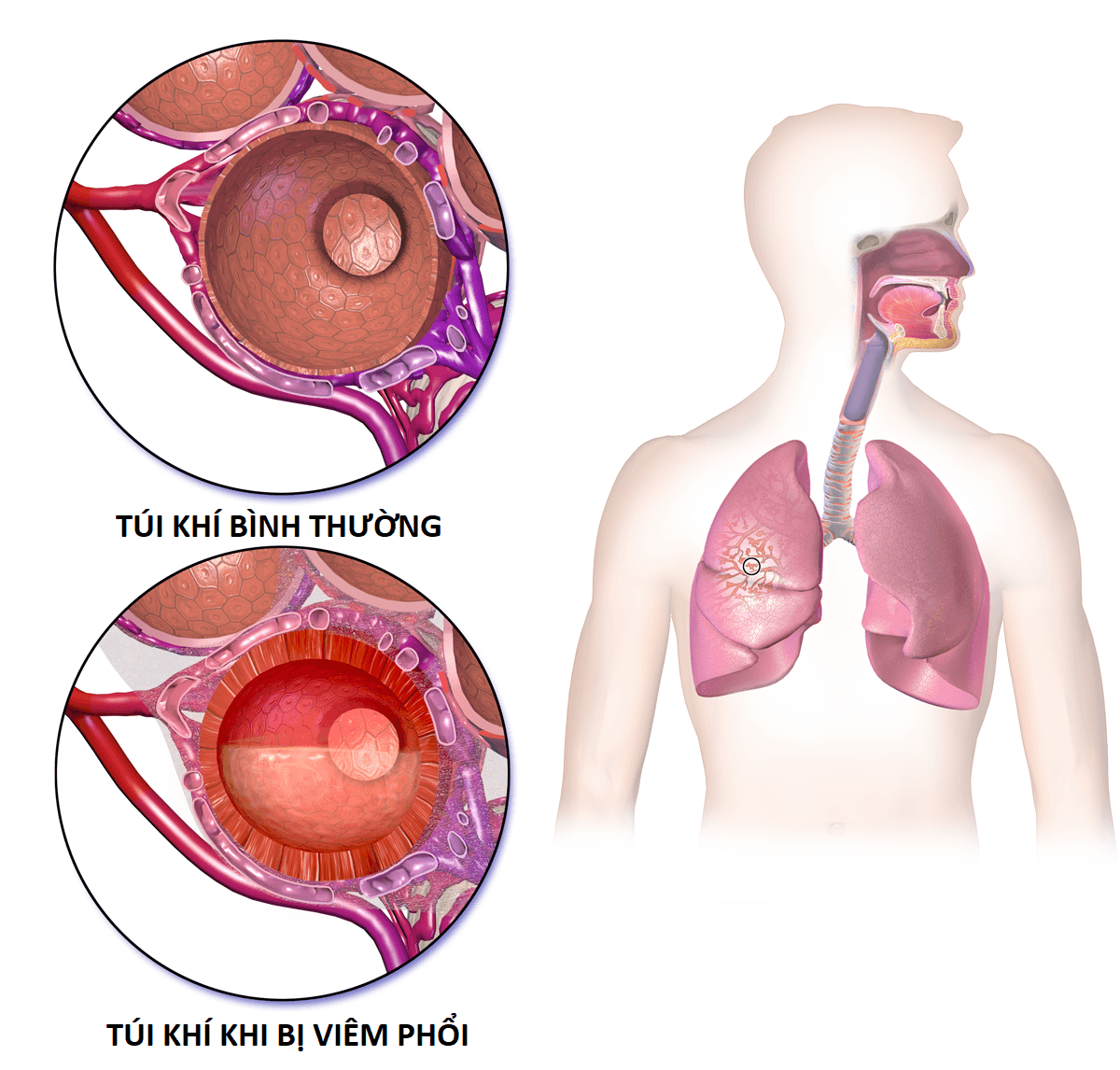 Những biện pháp phòng bệnh viêm phổi